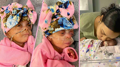 Kembar Prematur yang Divonis Peluang 0% Untuk Bertahan Hidup Kini Berkembang Pesat