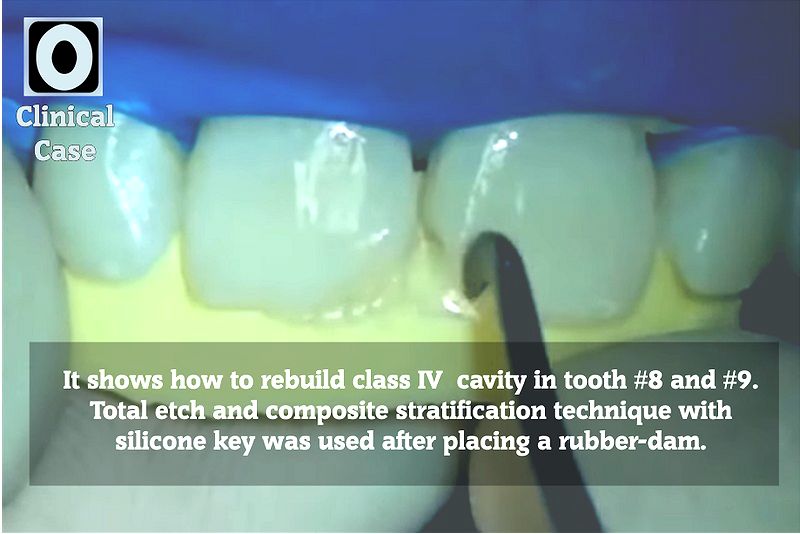 CLASS IV RESTORATION Stratification STEP BY STEP Dr David Gerdolle