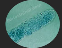 Urine Microscopic - Granular casts