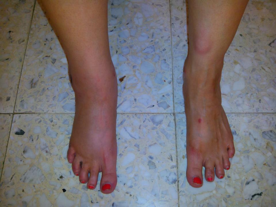 Brown Recluse Spider Bite Pictures Brown Recluse Spider Bite Pictures