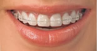 http://www.dentistinchennai.com/braces.php