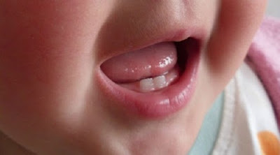 Răng sữa có vai trò quan trọng trong sự phát triển của trẻ