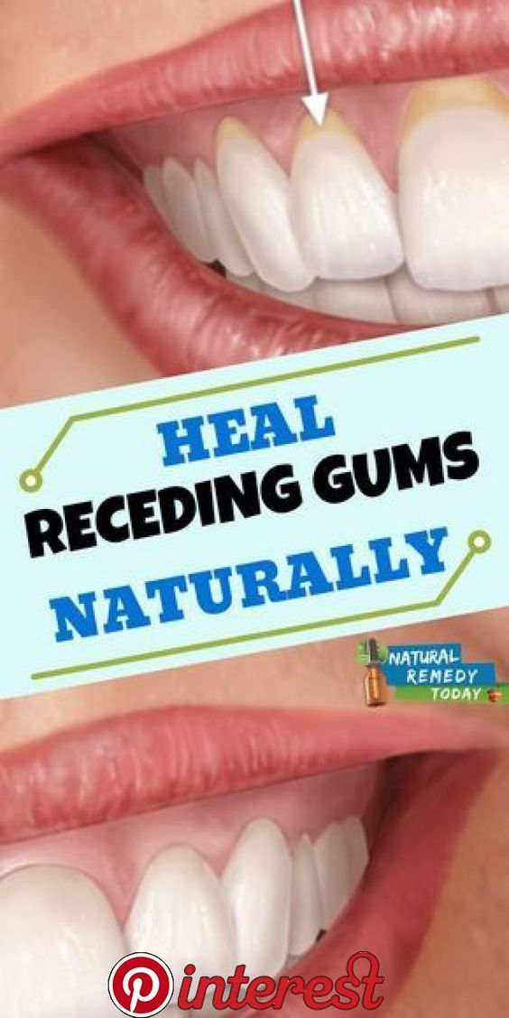 Healthy 4 10 Easy Ways to Heal Receding Gums Naturally!
