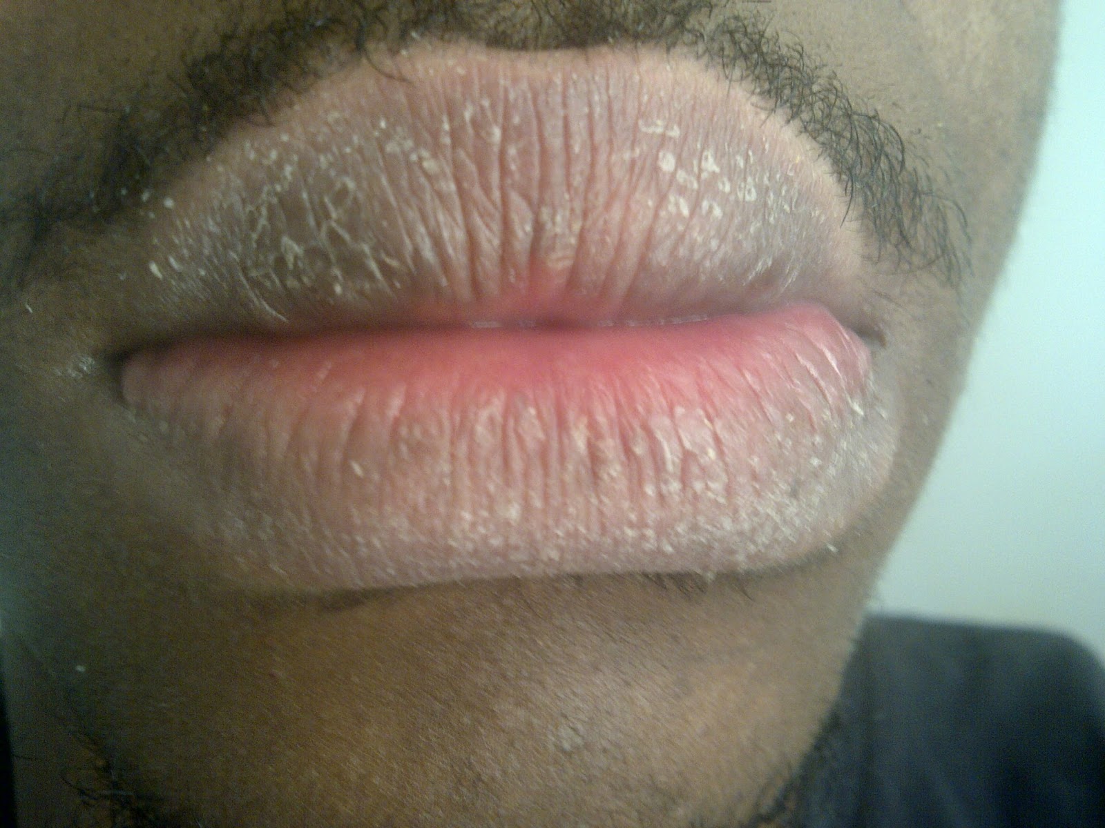 Dry Itchy Lips Pictures Photos
