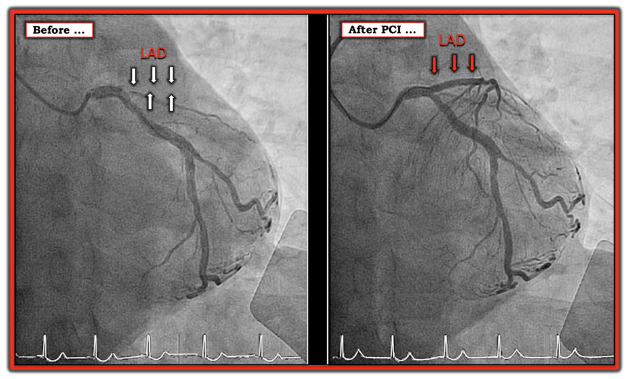 пмжв. ветви правой коронарной артерии. бифуркационный стеноз пмжв. коронарная артерия инфаркт миокарда. зоны кровоснабжения коронарных артерий.
