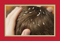  Head Louse Dream Meaning and Interpretations – DREAMLAND