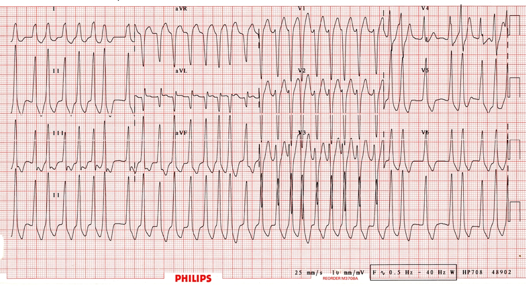 Case Reports in Anesthesia WPW syndrome in patient with significant