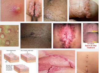 Beli Obat Alami Buat Kutil Kelamin di Apotik Surabaya