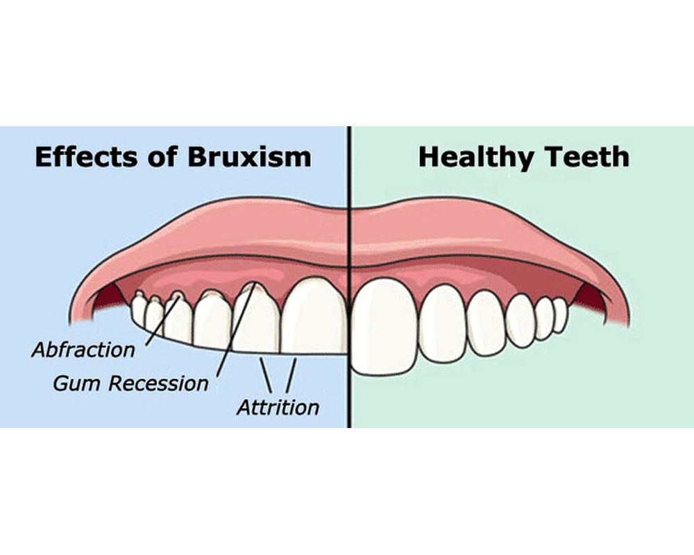 What are the consequences of bruxism? OdontoVida