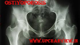 ऑस्टियोपोरोसिस के बारे में जाने - कारण - लक्षण और बचाव 