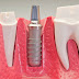 Tìm hiểu kỹ thuật trồng răng implant 