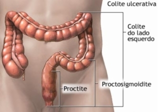 Colita Ulcerativa: Ce este, Simptome & Tratament | coronatravel.ro