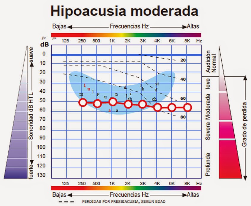 Hipoacusia en niños Hipoacusia en niños