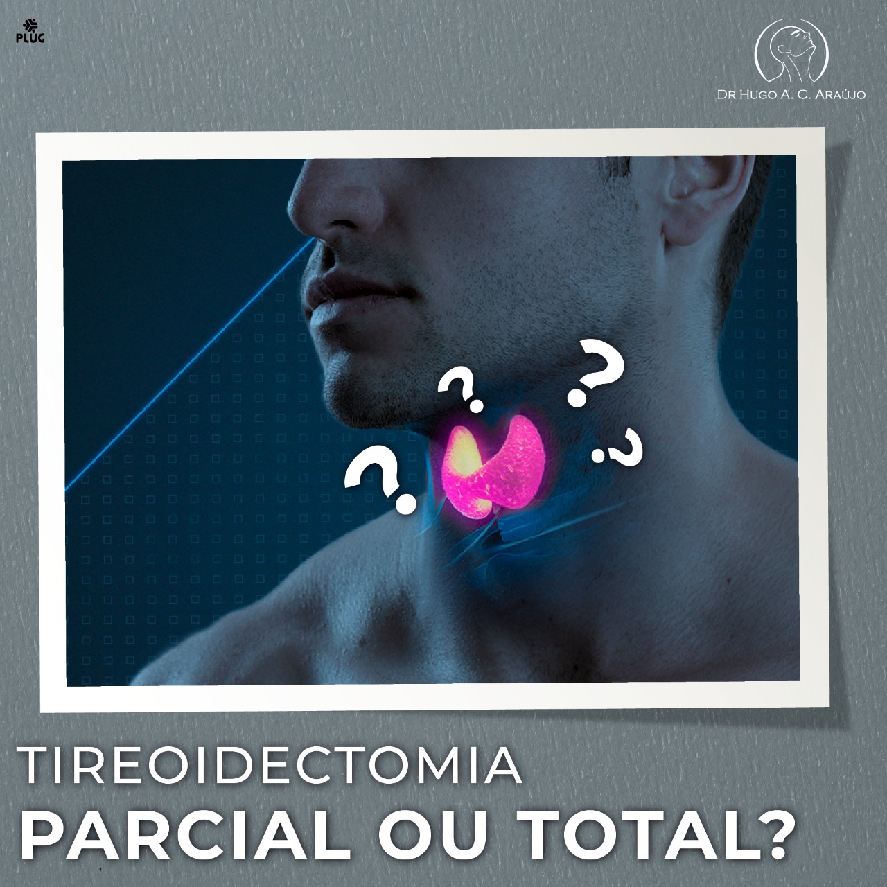Tireoidectomia parcial ou total?