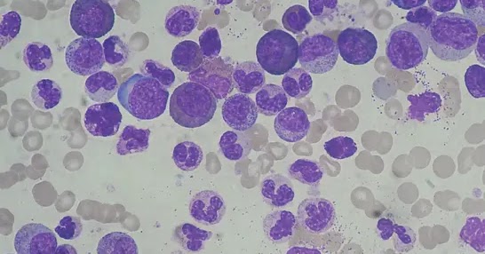 Chronic myeloid leukemia picture
