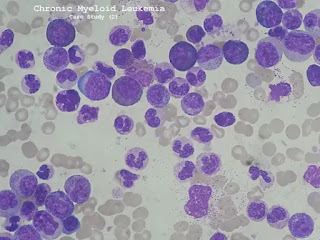 case study of chronic myeloid leukemia
