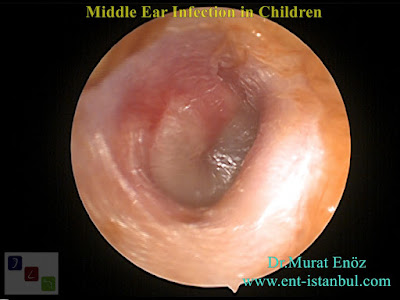 Symptoms of Middle Ear Infection in Children - Where The Microbes Come From to The Middle Ear? - What Are The Symptoms Of Middle Ear Infection? - What Are The Protective Measures For Middle Ear Infection? - Treatment Of Middle Ear Infection? Symptoms of Middle Ear Infection in Children - Where The Microbes Come From to The Middle Ear? - What Are The Symptoms Of Middle Ear Infection? - What Are The Protective Measures For Middle Ear Infection? - Treatment Of Middle Ear Infection?