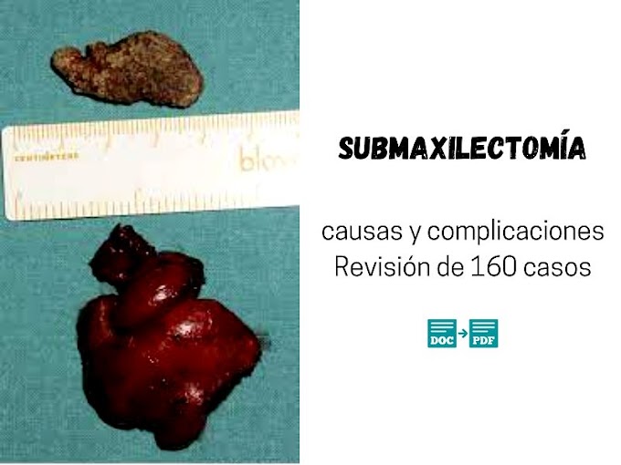 PDF: Submaxilectomía: causas y complicaciones