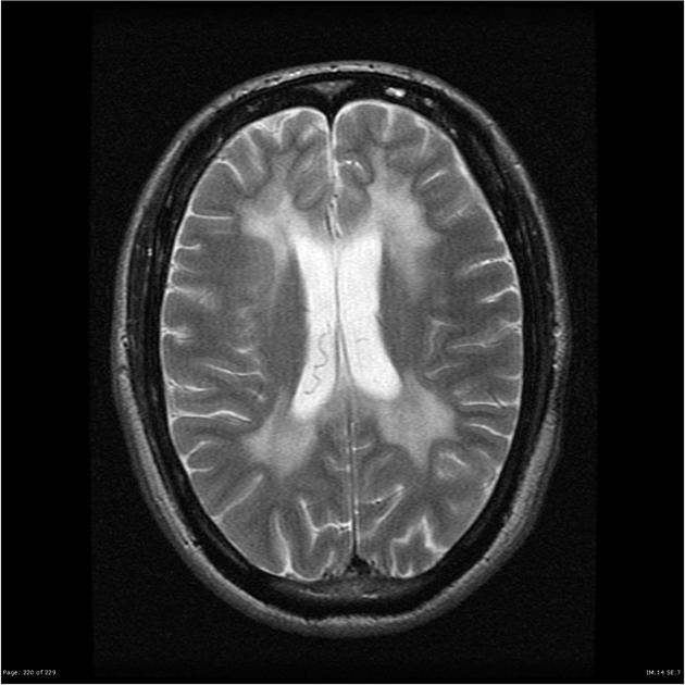 EL RINCÓN DE LA MEDICINA INTERNA LEUCODISTROFIA METACROMÁTICA. A