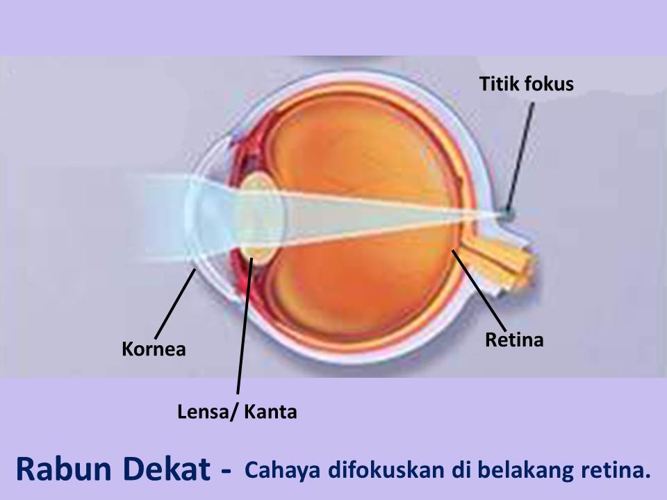 3 Petua untuk Merawat Rabun Dekat (Hiperopia) dengan Mudah | Penawar ...