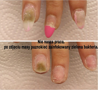 Mani Pedi Studio Zespol Zielonego Paznokcia Przyczyny Leczenie