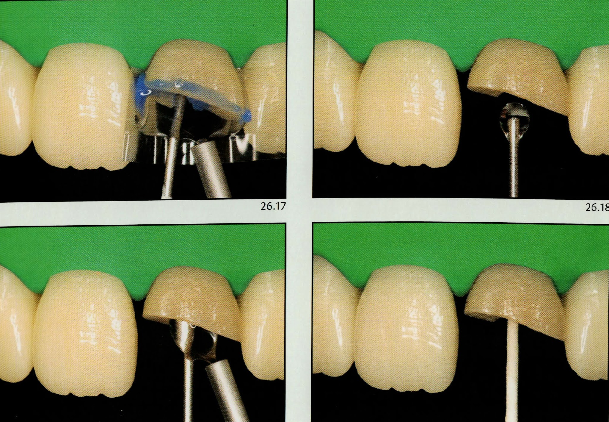 How to cement a fiber post ? Dental Esthetics