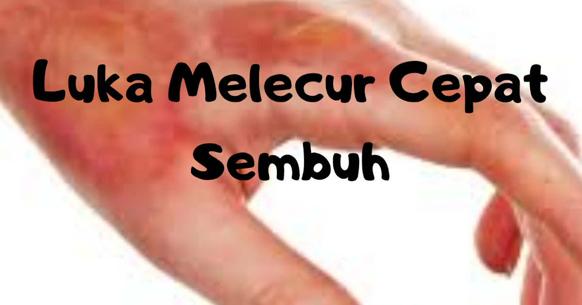 Cara Untuk Merawat Luka Melecur supaya cepat sembuh