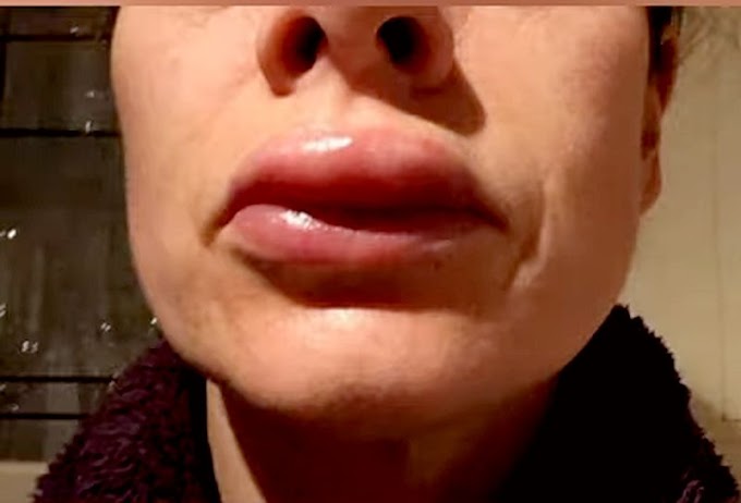 HYALURONIC ACID: Consequences after unsuccessful injections for lip contouring