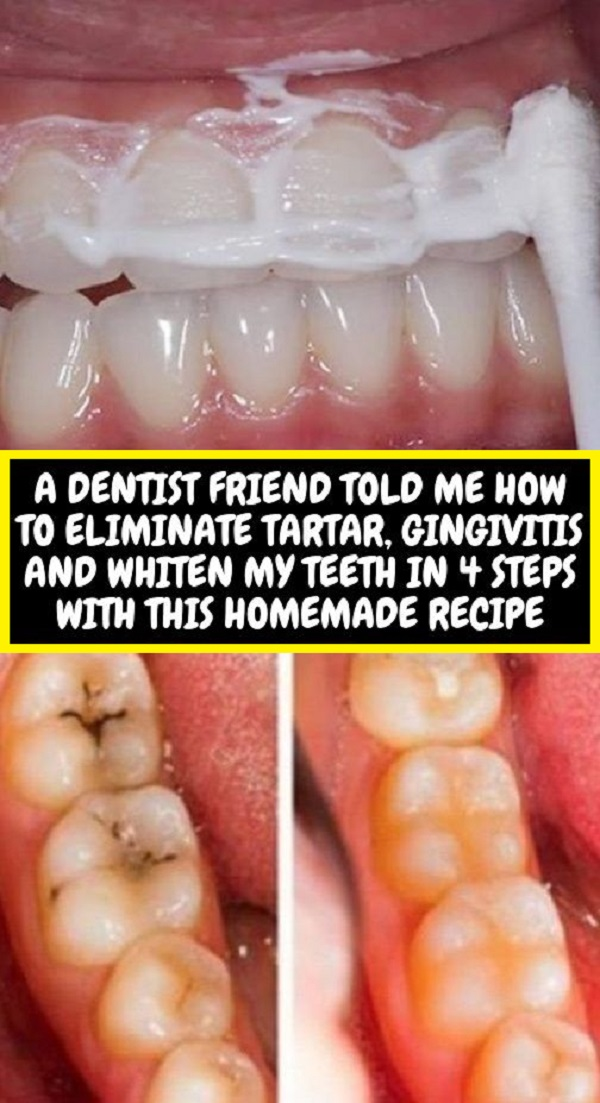 ELIMINATE TARTAR, GINGIVITIS AND WHITEN YOUR TEETH WITH THIS HOMEMADE