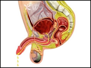 Pencegahan Penyakit Gonorrhea & Chlamydia