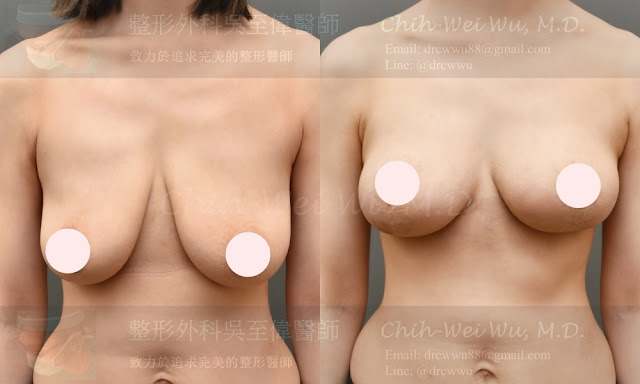 產後胸部下垂，接受胸部拉提〔提乳合併自體隆乳手術〕，左為術前，右為術後，提乳手術權威吳至偉醫師