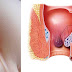 resep jamu wasir thumbnail