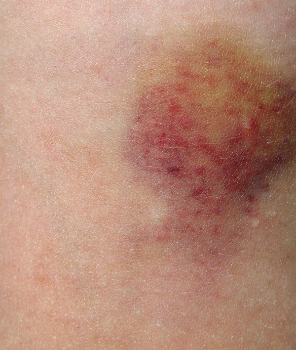 Pictures Of Bruises On Skin 12
