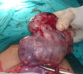 Left solid ovarian tumor(dysgerminoma) in adolescent girl