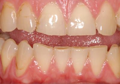Giải pháp hiệu quả nhất cho răng bị xỉn màu Rang-bi-xin-mau-la-do-dau