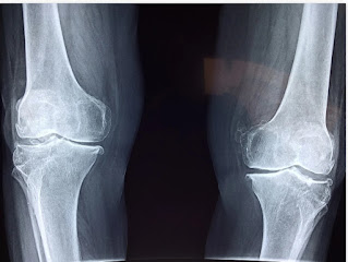 Deposit in joints can cause pain