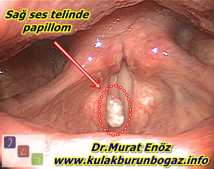 hpv tumor a torokban