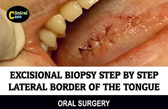 EXCISIONAL BIOPSY: Lateral border of the tongue Step by Step