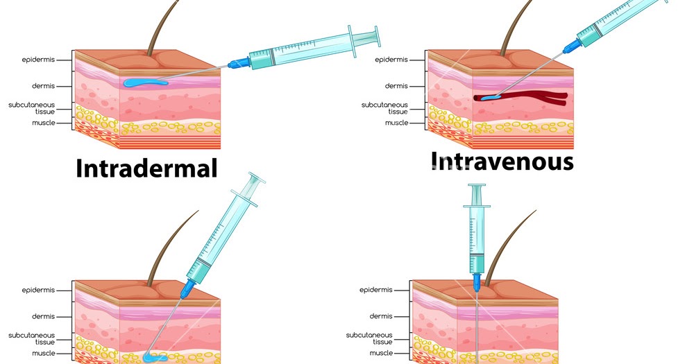 intradermal enjeksiyon