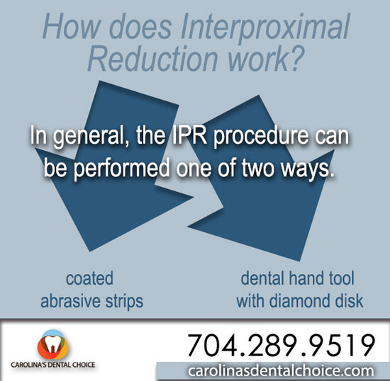 How To Simplify Interproximal Reduction