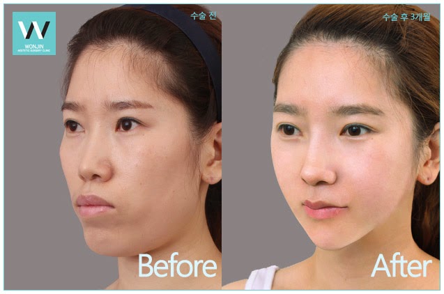 Челюстно лицевая хирургия до после - TouristMaps.ru