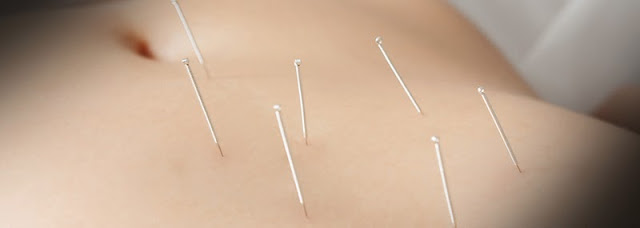 Acupuntura para adelgazar Agujas de acupuntura en el abdomen