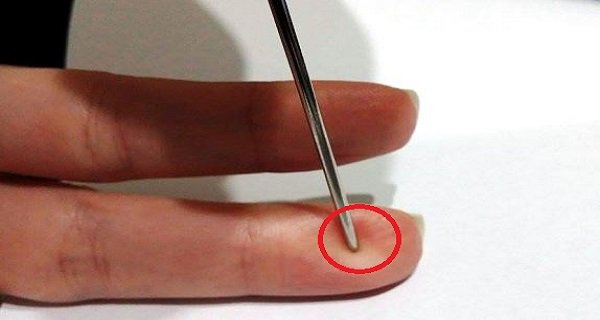 How This Simple Needle Can Save You From a Stroke?