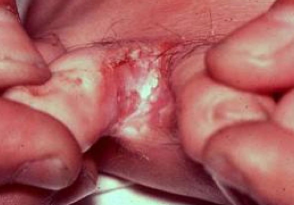 toe infections pictures #11