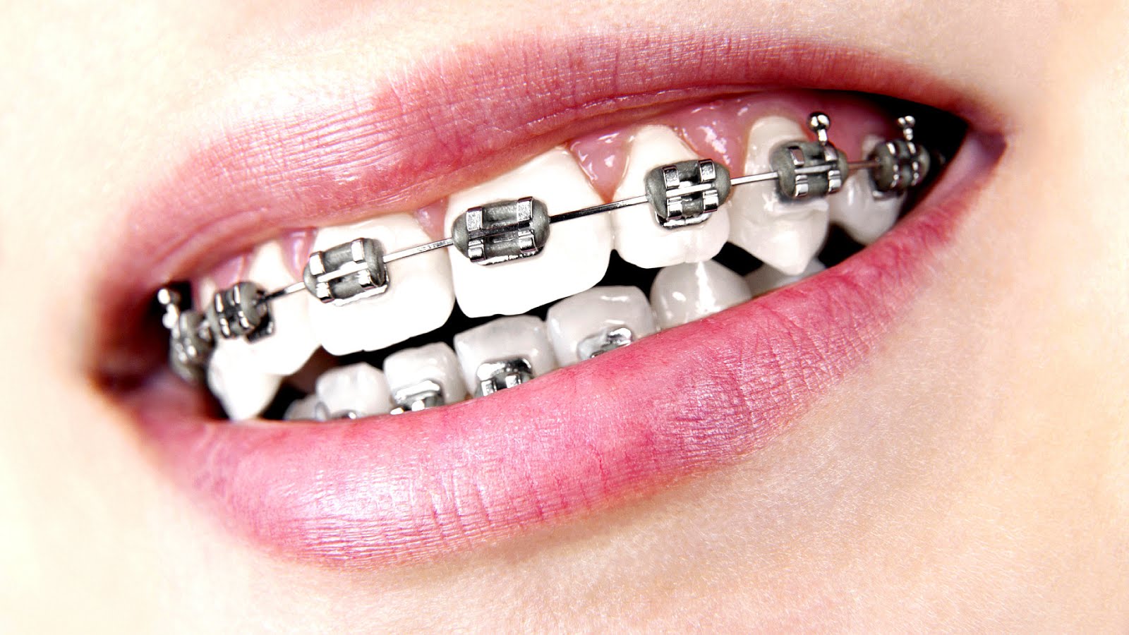 How To Have White Teeth With Braces White Choices