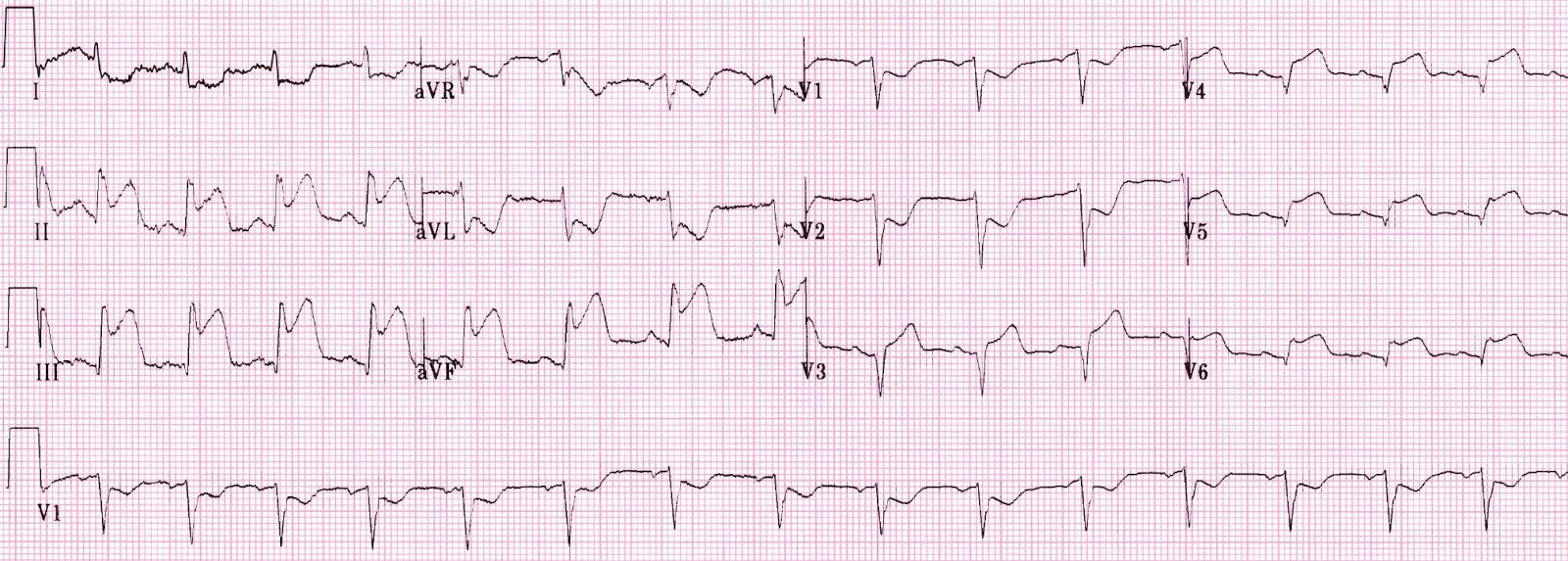 Study Medical Photos: Acute Right Ventricular Myocardial ...