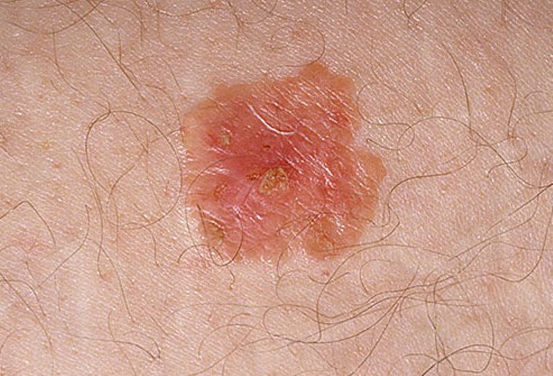 pictures-of-skin-cancer-skin-cancer-white-spots