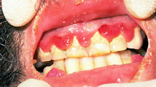 Poor oral health is associated with lack of vitamin C scurvy pictures