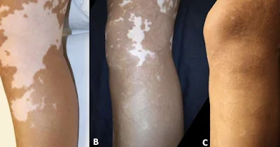 Vitiligo en la rodilla y pierna-Trasplante de Melanocitos-Tratamiento para el vitiligo