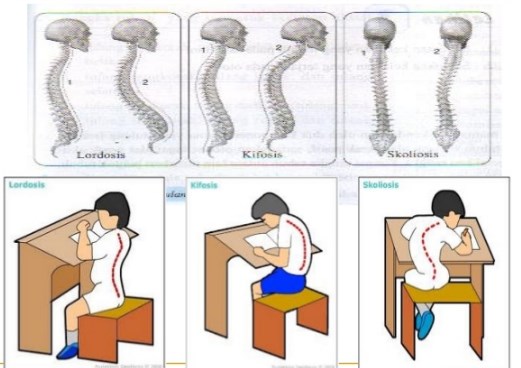 Gangguan pada Sistem Gerak